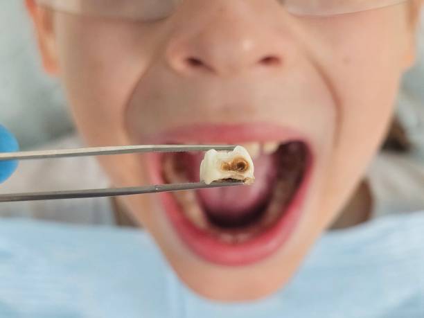 Best Emergency Treatment for Dental Infections or Abscesses in Groesbeck, TX