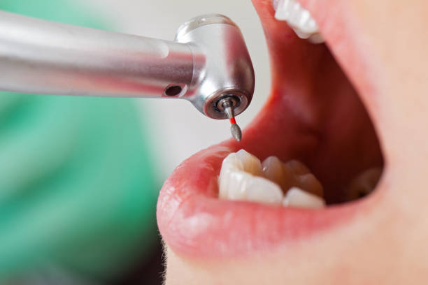 Best Emergency Dental Care for Broken or Chipped Teeth in Groesbeck, TX
